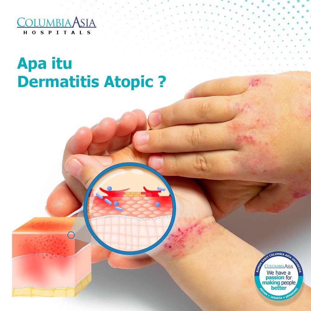 Detail Gambar Penyakit Dermatitis Atopik Nomer 26