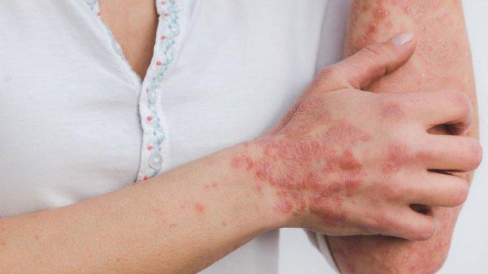 Detail Gambar Penyakit Dermatitis Atopik Nomer 27