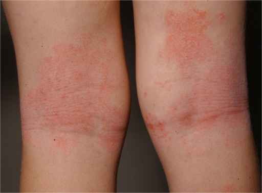 Detail Gambar Penyakit Dermatitis Atopik Nomer 4