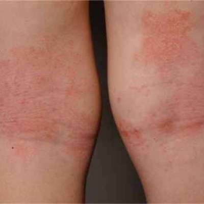 Detail Gambar Penyakit Dermatitis Atopik Nomer 28