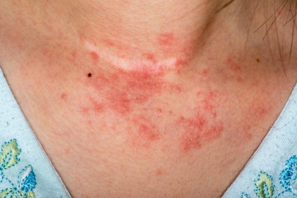 Detail Gambar Penyakit Dermatitis Atopik Nomer 32