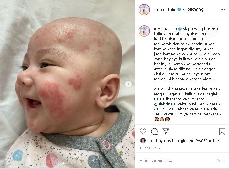 Detail Gambar Penyakit Dermatitis Atopik Nomer 33