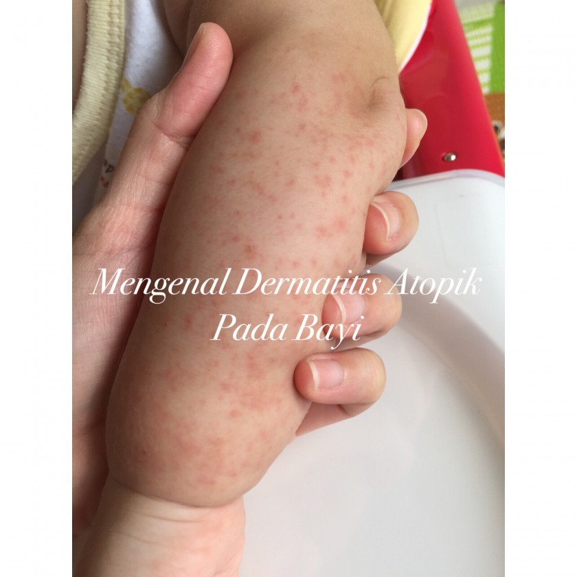 Detail Gambar Penyakit Dermatitis Atopik Nomer 35