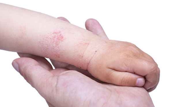 Download Gambar Penyakit Dermatitis Atopik Nomer 5