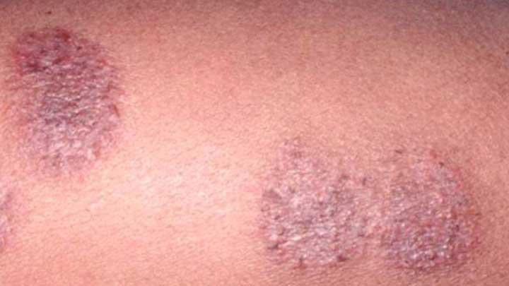 Download Gambar Penyakit Dermatitis Atopik Nomer 36