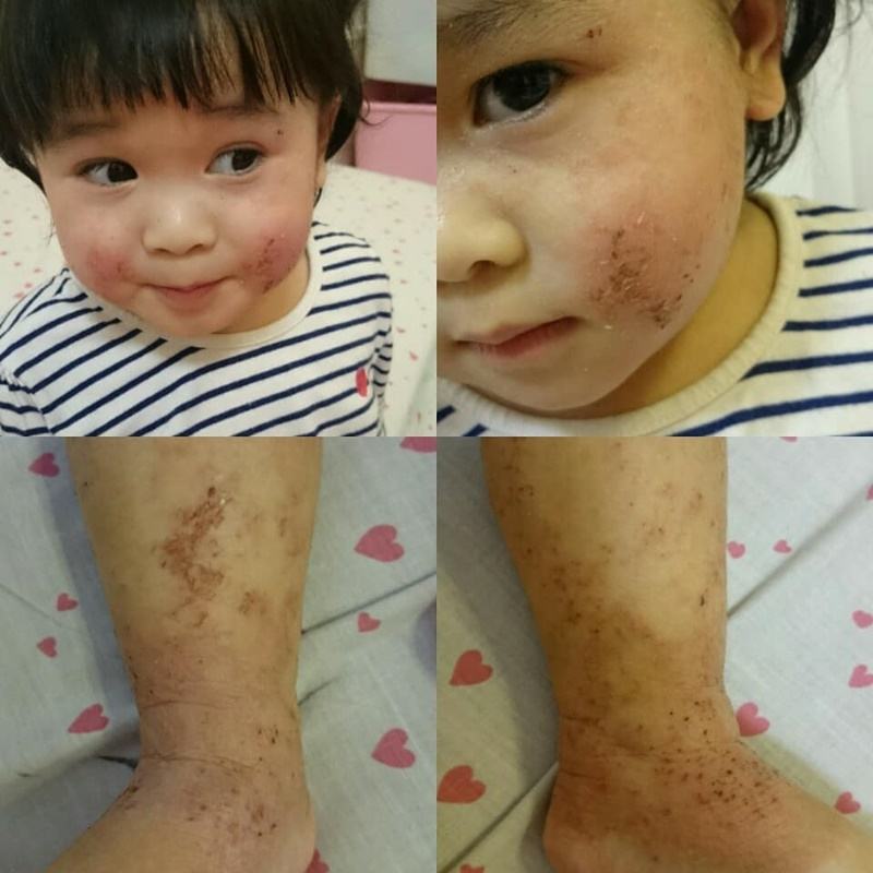Detail Gambar Penyakit Dermatitis Atopik Nomer 37