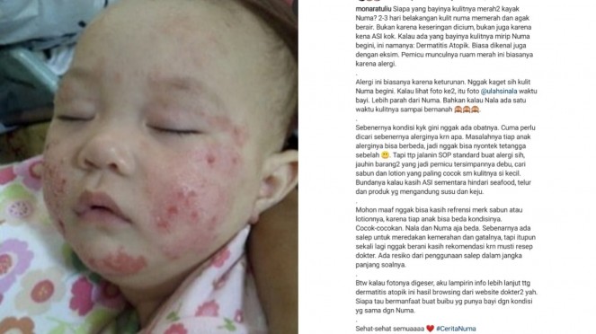 Detail Gambar Penyakit Dermatitis Atopik Nomer 38