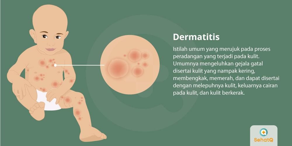 Detail Gambar Penyakit Dermatitis Atopik Nomer 39