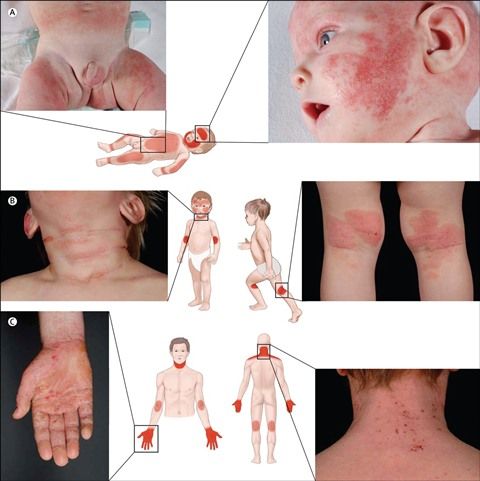 Detail Gambar Penyakit Dermatitis Atopik Nomer 40