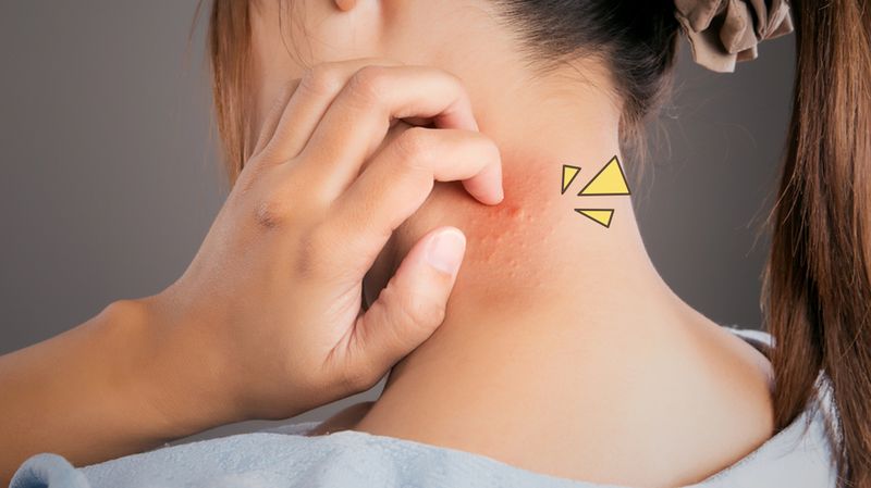 Detail Gambar Penyakit Dermatitis Atopik Nomer 44