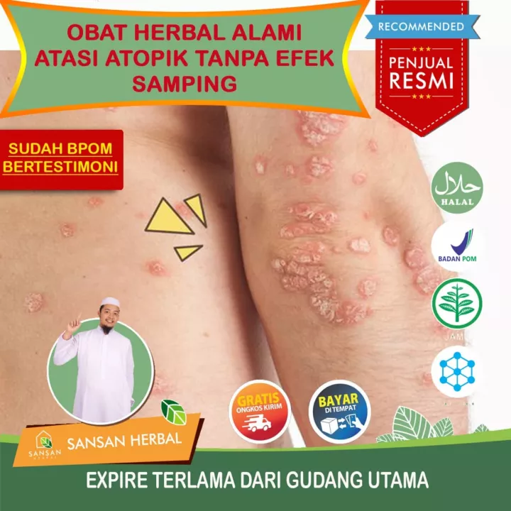 Detail Gambar Penyakit Dermatitis Atopik Nomer 47