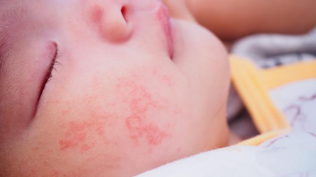 Detail Gambar Penyakit Dermatitis Atopik Nomer 9