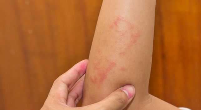 Gambar Penyakit Dermatitis Kontak - KibrisPDR