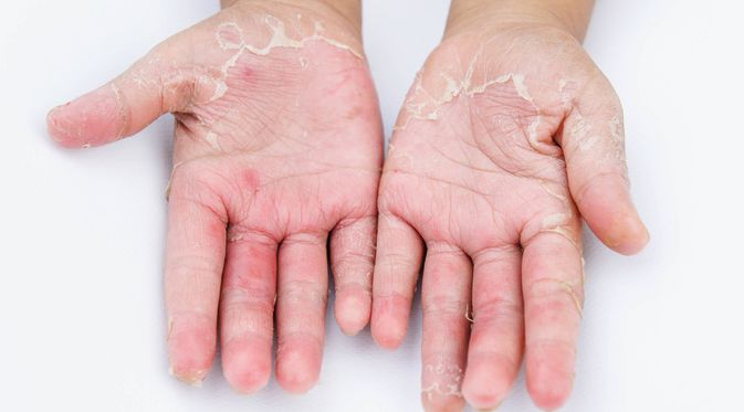 Detail Gambar Penyakit Dermatitis Kontak Nomer 2