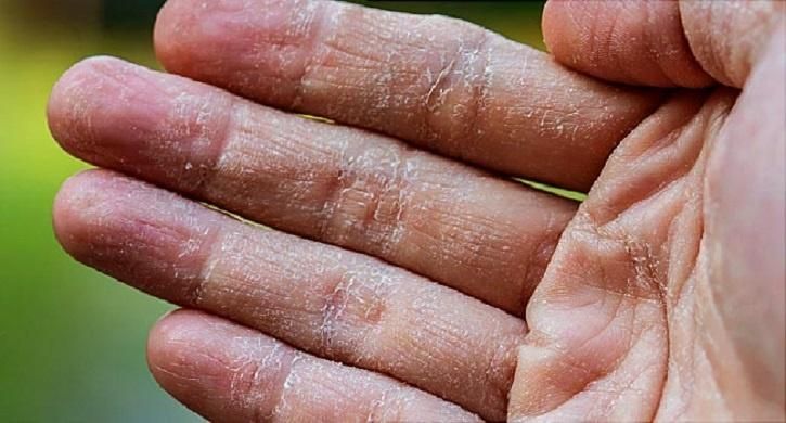 Detail Gambar Penyakit Dermatitis Kontak Nomer 10