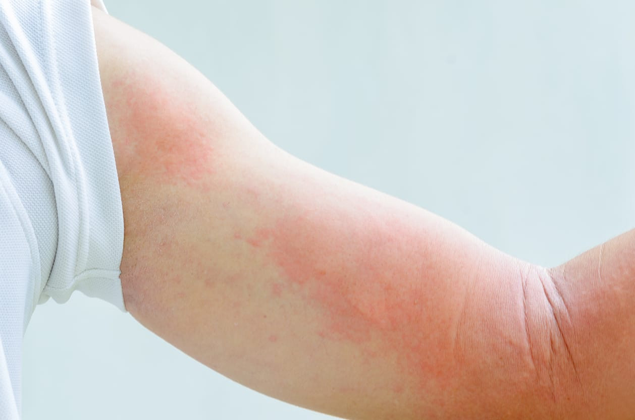 Detail Gambar Penyakit Dermatitis Kontak Nomer 11
