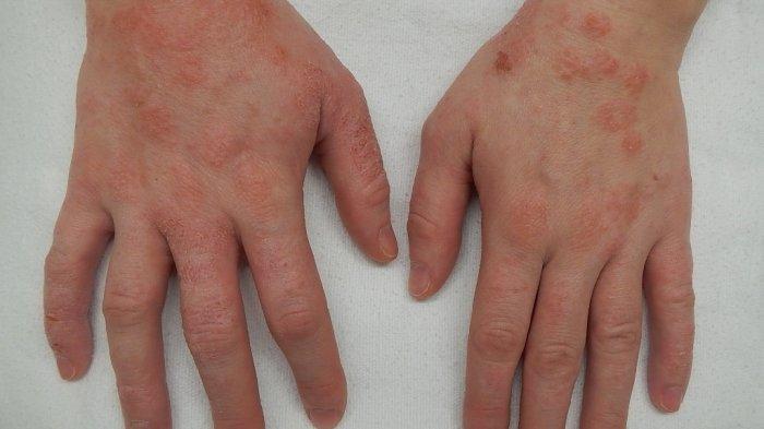 Detail Gambar Penyakit Dermatitis Kontak Nomer 12