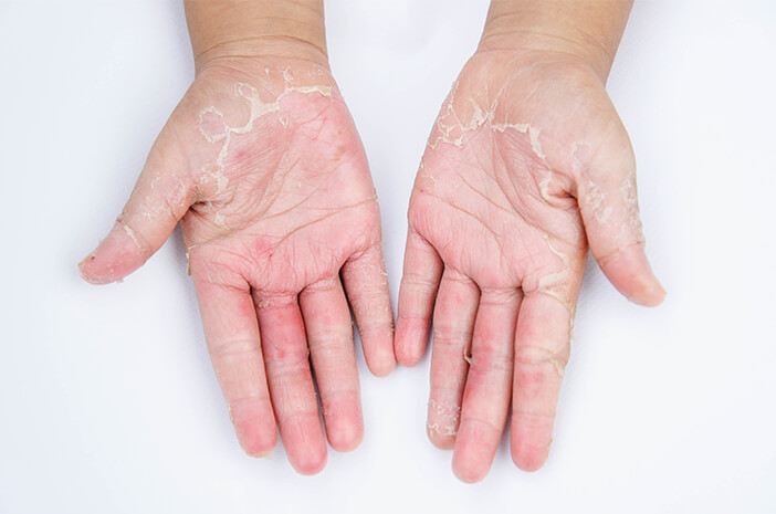 Detail Gambar Penyakit Dermatitis Kontak Nomer 13