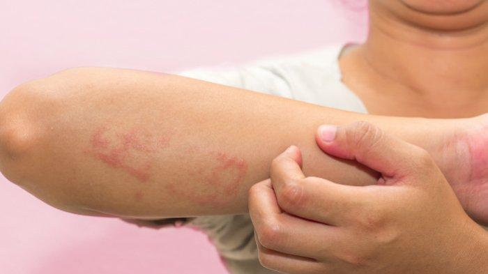 Detail Gambar Penyakit Dermatitis Kontak Nomer 14