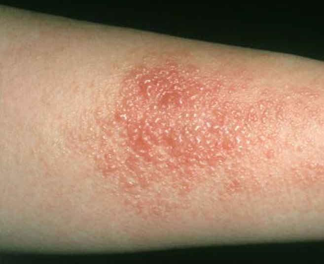 Detail Gambar Penyakit Dermatitis Kontak Nomer 18