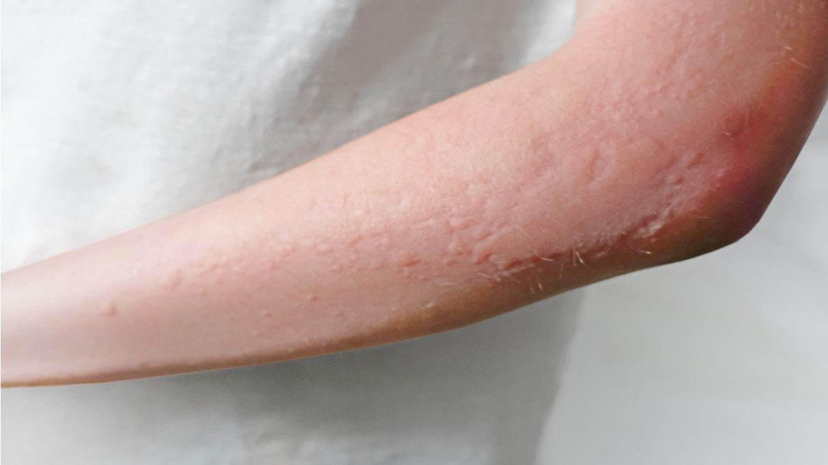Detail Gambar Penyakit Dermatitis Kontak Nomer 3