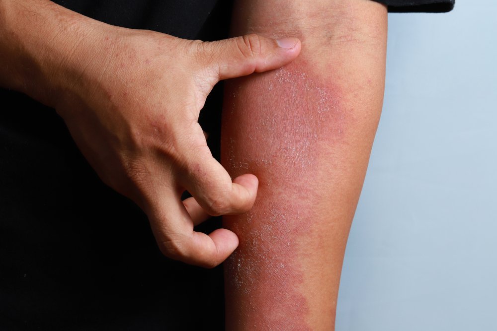 Detail Gambar Penyakit Dermatitis Kontak Nomer 21