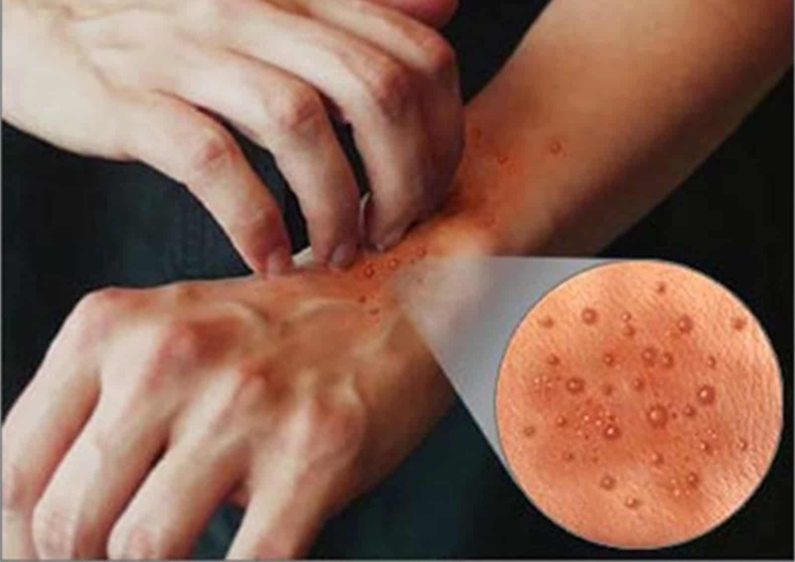 Detail Gambar Penyakit Dermatitis Kontak Nomer 22