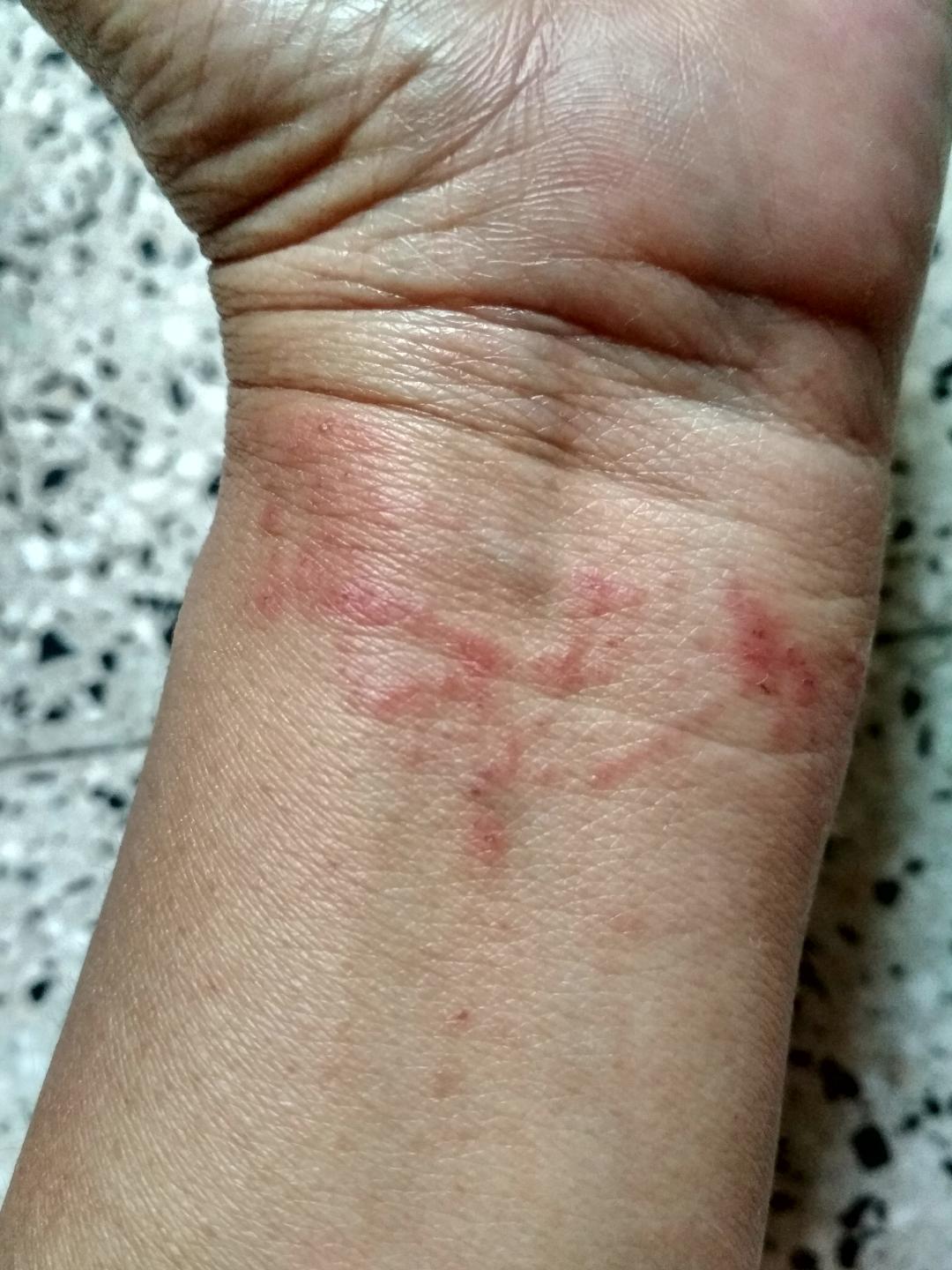 Detail Gambar Penyakit Dermatitis Kontak Nomer 24