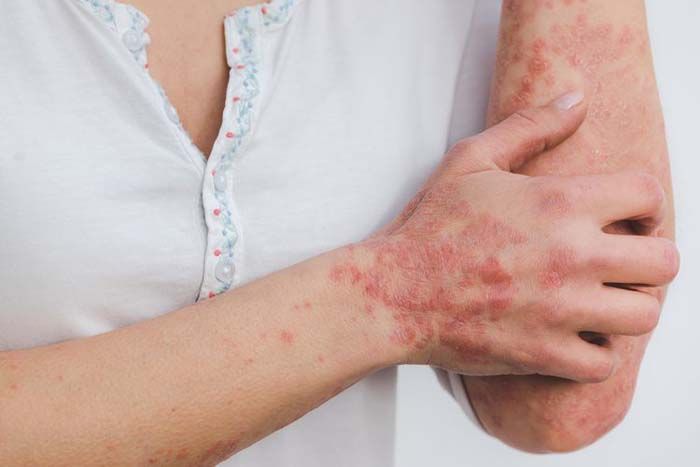 Detail Gambar Penyakit Dermatitis Kontak Nomer 26