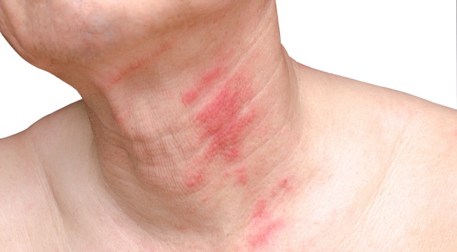 Detail Gambar Penyakit Dermatitis Kontak Nomer 27