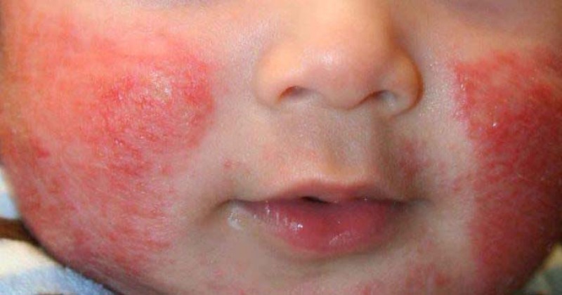 Detail Gambar Penyakit Dermatitis Kontak Nomer 28