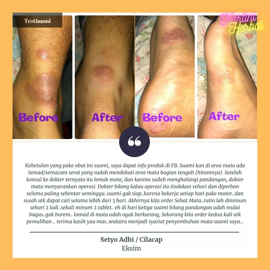 Detail Gambar Penyakit Dermatitis Kontak Nomer 30