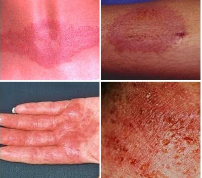 Detail Gambar Penyakit Dermatitis Kontak Nomer 31