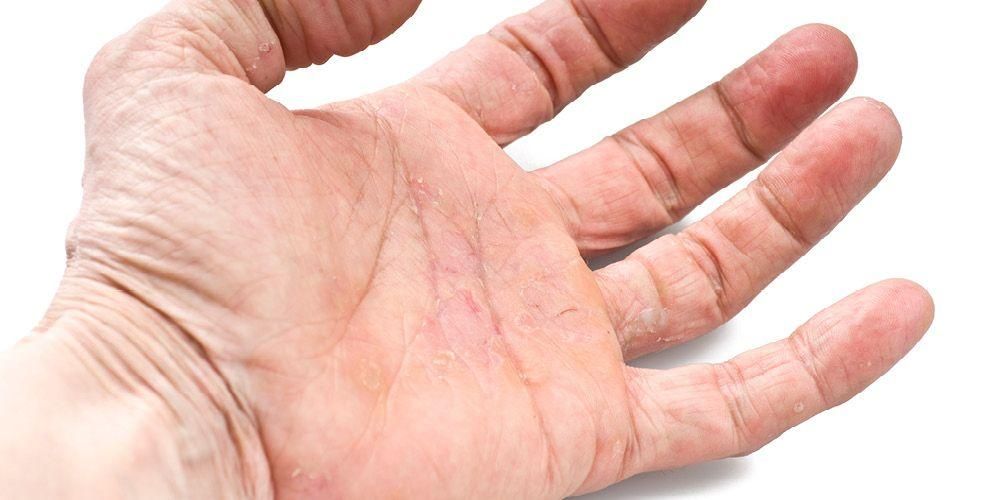 Detail Gambar Penyakit Dermatitis Kontak Nomer 32