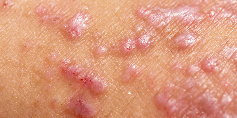 Detail Gambar Penyakit Dermatitis Kontak Nomer 33