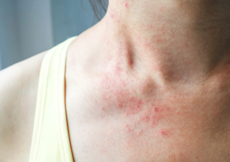 Detail Gambar Penyakit Dermatitis Kontak Nomer 35