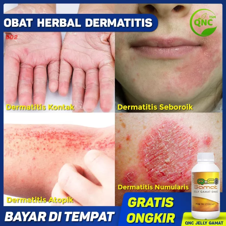 Detail Gambar Penyakit Dermatitis Kontak Nomer 36