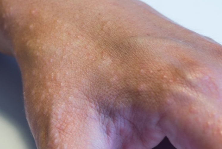 Detail Gambar Penyakit Dermatitis Kontak Nomer 37