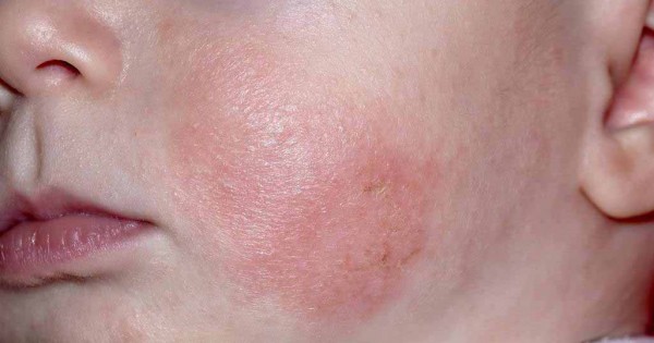 Detail Gambar Penyakit Dermatitis Kontak Nomer 38