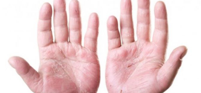 Detail Gambar Penyakit Dermatitis Kontak Nomer 39