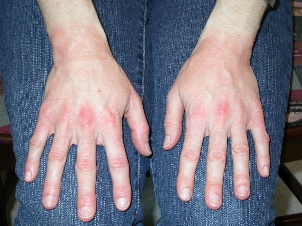 Detail Gambar Penyakit Dermatitis Kontak Nomer 41