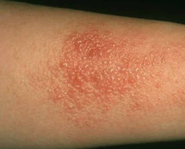 Detail Gambar Penyakit Dermatitis Kontak Nomer 42