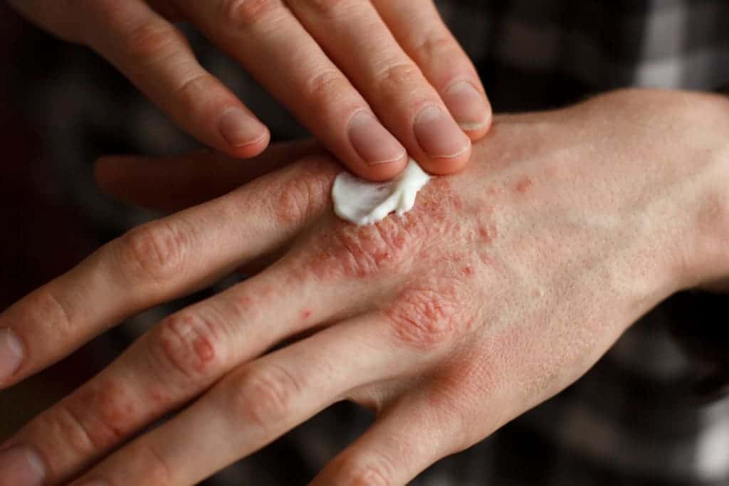 Detail Gambar Penyakit Dermatitis Kontak Nomer 6