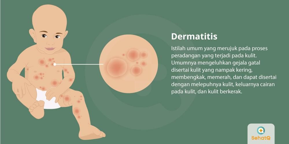 Detail Gambar Penyakit Dermatitis Kontak Nomer 45