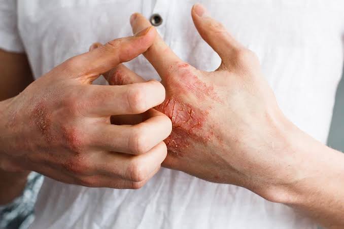 Detail Gambar Penyakit Dermatitis Kontak Nomer 46