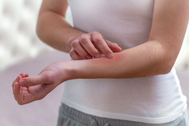 Detail Gambar Penyakit Dermatitis Kontak Nomer 48
