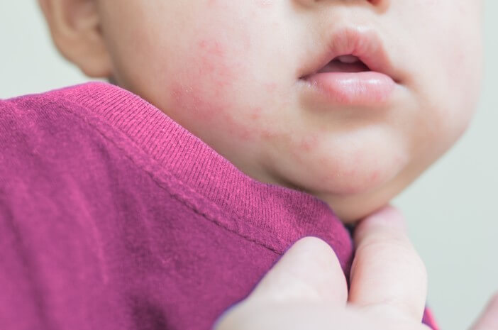 Detail Gambar Penyakit Dermatitis Kontak Nomer 49