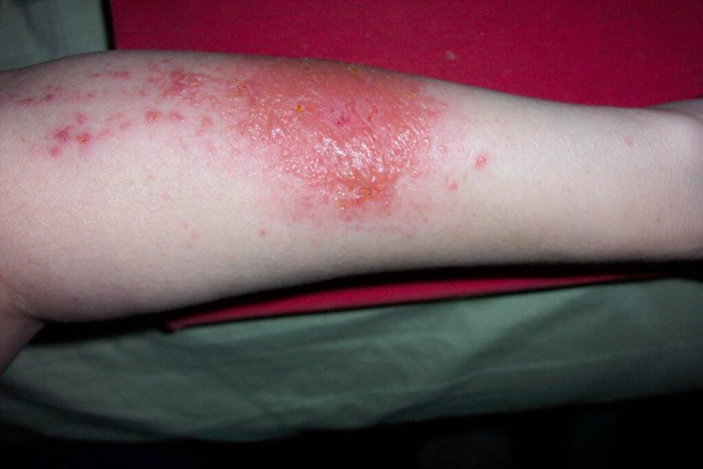 Detail Gambar Penyakit Dermatitis Kontak Nomer 50