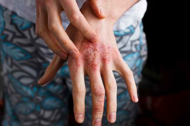 Detail Gambar Penyakit Dermatitis Kontak Nomer 7