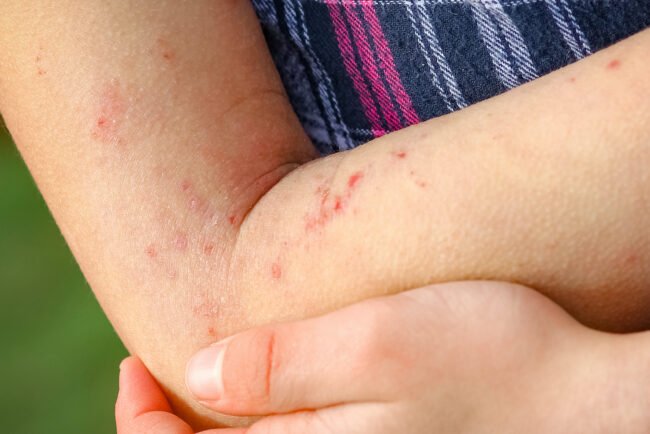 Detail Gambar Penyakit Dermatitis Kontak Nomer 8